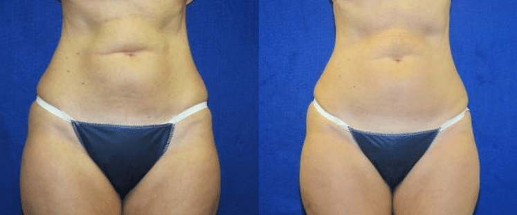 Which Body Contouring Treatment Is Right for Me?