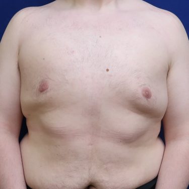 Male Breast Reduction Archives - Wilson Plastic Surgery