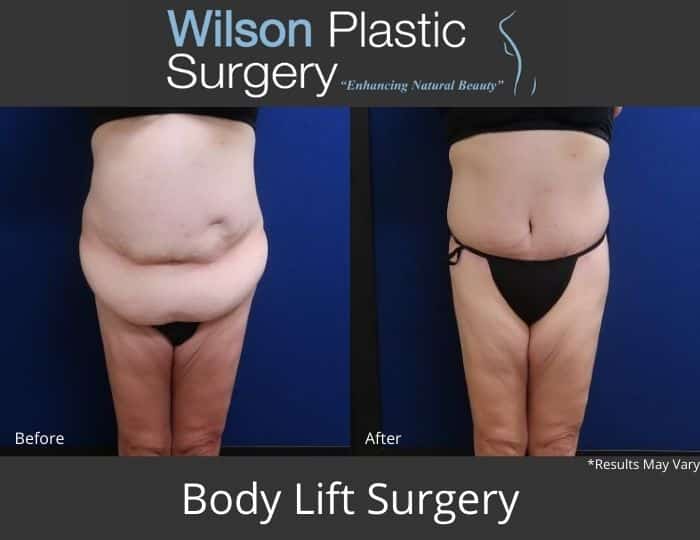 Body Contouring After Weight Loss - Fort Worth - Kirby Plastic Surgery