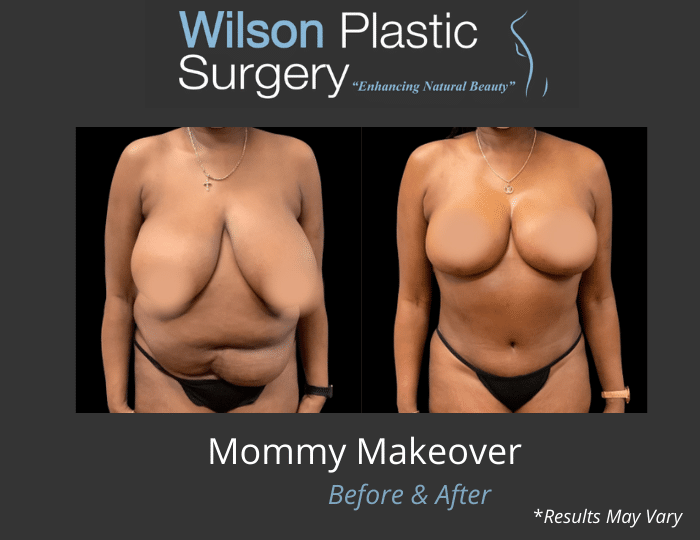 Steely Plastic Surgery - Before & After: 32 year old woman had breast  augmentation by a different surgeon about 8 years ago. She was not happy  with the shape or size of