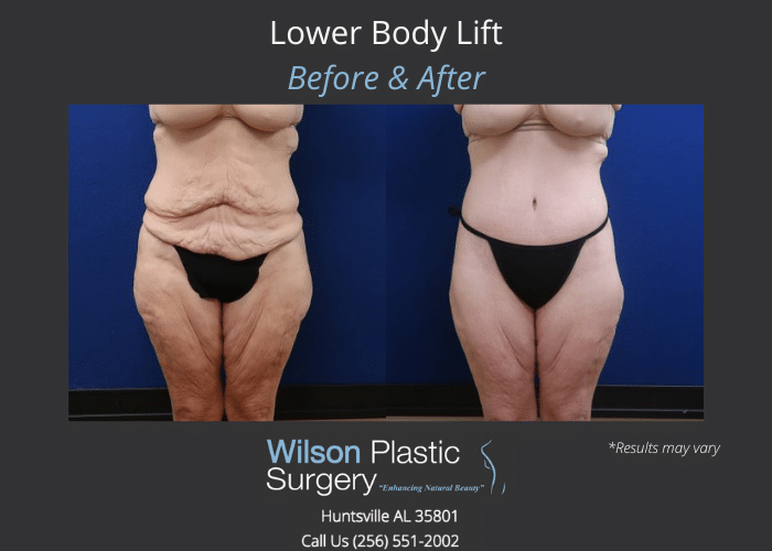 What Is the Difference Between Cosmetic Body Contouring and Weight-Loss  Surgery?